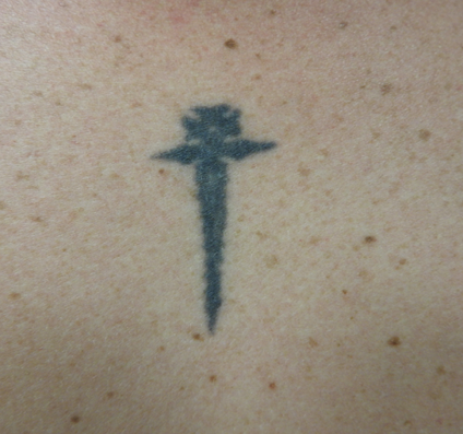Tattoo removal with Harmony Before