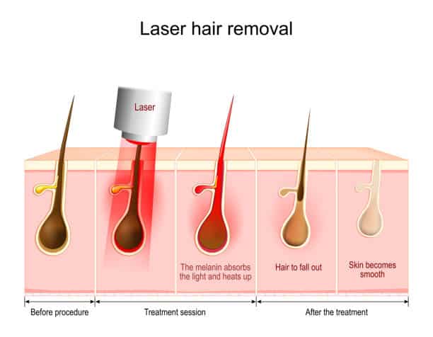 How Laser Hair Removal Works?