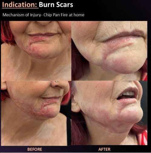 Long-term partnership helps survivors living with traumatic scars access advanced laser and regenerative treatments to support their recovery journey. Long-term partnership helps survivors living with traumatic scars access advanced laser and regenerative treatments to support their recovery journey.